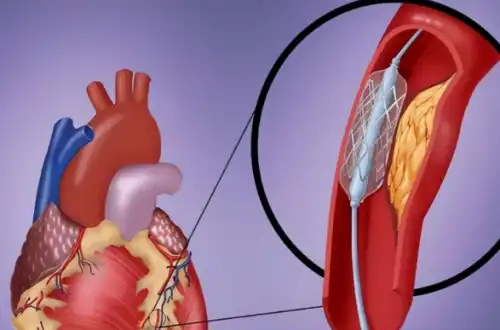 titanium in heart stents titanium in heart stents