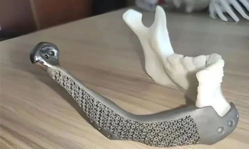 Titanium alloy dental implants