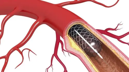 medical titanium alloy stents medical titanium alloy stents