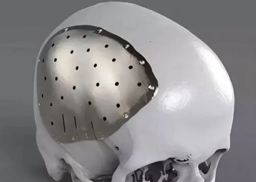 Titanium in Orthopedic Applications Titanium in Orthopedic Applications