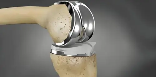 Manufacturing and processing of orthopedic medical titanium alloy parts