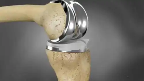 titanium alloys in human joints
