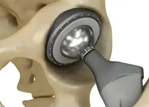 Titanium alloy orthopedic materials Titanium alloy orthopedic materials